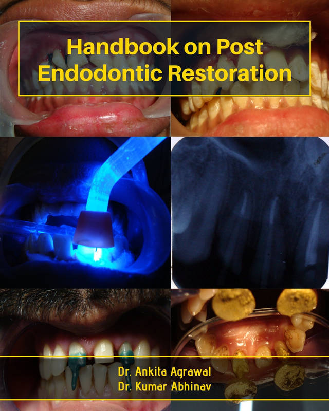 Handbook on Post Endodontic Restoration