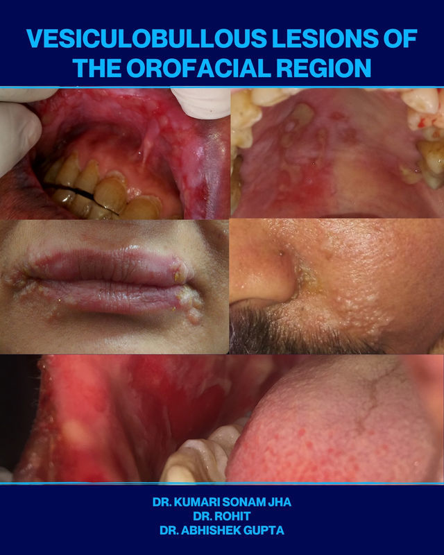 Vesiculobullous Lesions of the Orofacial Region