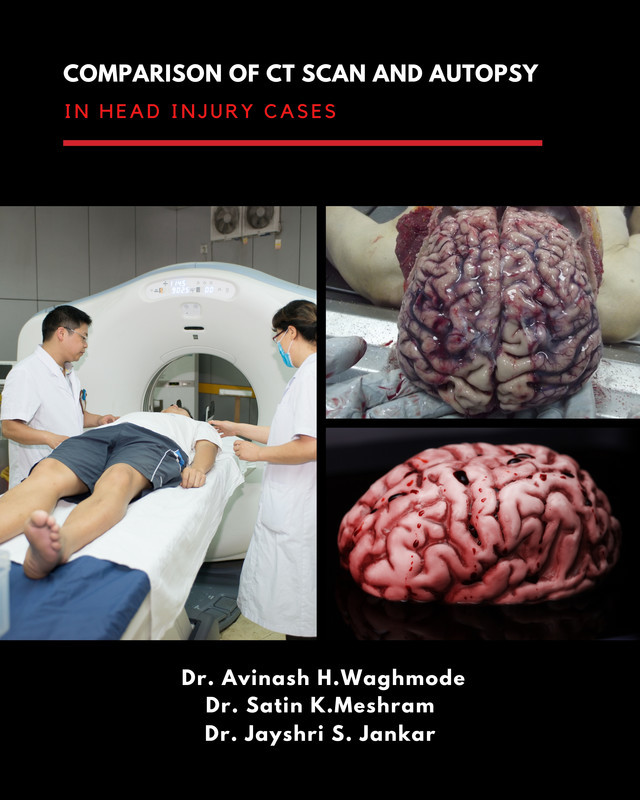 Comparison of CT scan and Autopsy in Head Injury cases